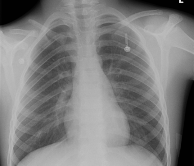 Congenital Clavicle Pseuodarthrosis